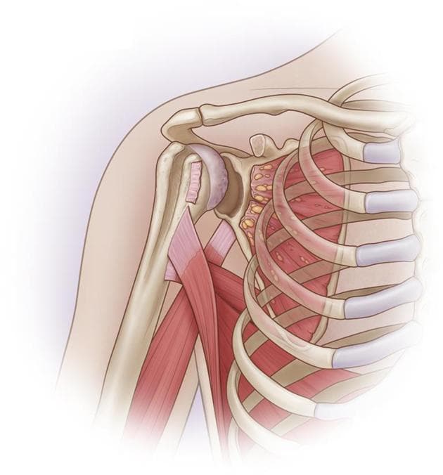 This medical anatomical diagram illustrates a right shoulder joint (glenohumeral joint) with significant orthopedic pathology. The illustration reveals an anterior-inferior bone defect of the glenoid, representing a structural loss of bone mass in the lower-front rim of the socket. Accompanying this bony lesion is a complete, irreparable tear of the subscapularis tendon, shown as a discontinuous and retracted muscle-tendon unit. A notable anatomical abnormality is the absence of the coracoid process, which typically serves as a landmark and attachment point for the conjoint tendon. The humeral head shows signs of degenerative wear, and the surrounding thoracic cage (ribs and intercostal muscles) and clavicle are depicted for orientation. The diagram serves as an educational tool for identifying combined soft-tissue and bony instability in the shoulder, often requiring complex reconstructive procedures like bone grafting or muscle transfer.