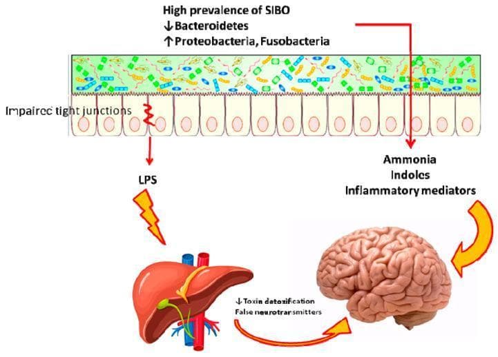 This pathophysiology diagram illustrates the role of Small Intestinal Bacterial Overgrowth (SIBO) and gut dysbiosis in the development of hepatic encephalopathy (HE). The upper section depicts an intestinal lumen with a high prevalence of bacteria, noting a decrease in Bacteroidetes and an increase in Proteobacteria and Fusobacteria. Below the lumen, a row of intestinal epithelial cells shows impaired tight junctions, representing increased intestinal permeability ('leaky gut'). Red arrows track the translocation of harmful substances through this compromised barrier: Lipopolysaccharides (LPS) are shown migrating toward the liver, while ammonia, indoles, and inflammatory mediators are shown moving toward the brain. The diagram highlights the gut-liver-brain axis, showing how liver dysfunction (characterized by decreased toxin detoxification and the presence of false neurotransmitters) further impacts the brain. This visual summarizes how intestinal dysbiosis leads to systemic endotoxemia and neurotoxicity, contributing to the pathogenesis of hepatic encephalopathy in patients with liver disease.
