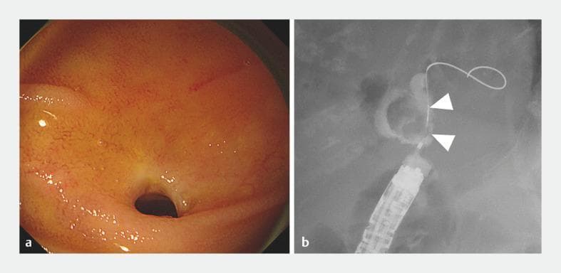 This composite clinical figure illustrates a case of obstructive jaundice due to a large common bile duct stone managed via enteroscopy-assisted ERCP. Panel 'a' shows an endoscopic view of the choledochojejunostomy anastomosis. The lumen exhibits a mild stricture surrounded by pinkish-orange mucosa with fine vascular patterns and glistening surface texture. Panel 'b' is a fluoroscopic cholangiography image using radiopaque contrast to opacify the biliary tree. White arrowheads point to a prominent 20-mm radiolucent filling defect within the bile duct, characteristic of a large obstructive biliary stone. Visible instrumentation includes a multi-segmented overtube and a looped guidewire facilitating access to the hilum. These images demonstrate the diagnostic utility of balloon-assisted enteroscopy for evaluating post-surgical anatomy (pancreaticoduodenectomy) and identifying mechanical obstructions in the biliary system.