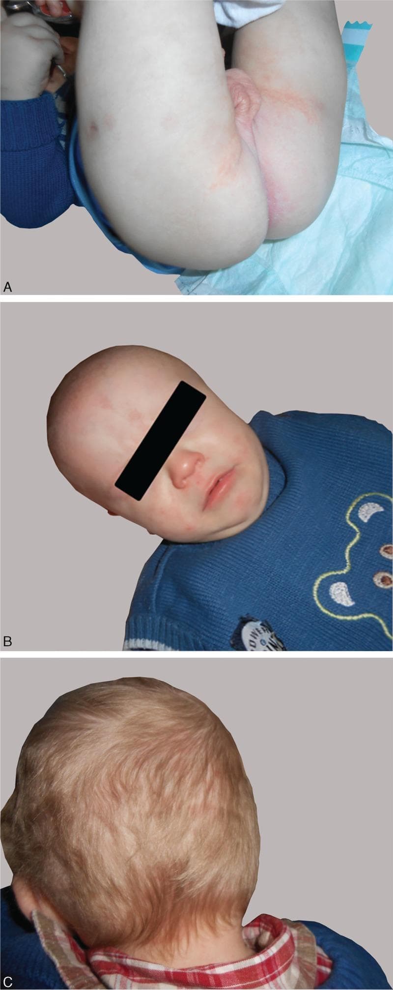 A composite of three clinical photographs (A, B, C) showing a pediatric patient following two months of treatment for acrodermatitis enteropathica. Panel A illustrates the diaper area (buttocks and perianal region), showing significant resolution of previous erythematous, scaly, and pustular lesions; the skin appears mostly clear with minimal residual faint pink patches within the gluteal folds. Panel B displays the infant's face, demonstrating remission of perioral and periorificial dermatitis, with a clear facial complexion and absence of acute inflammation around the mouth and nose. Panel C provides a posterior view of the scalp, showing successful hair regrowth following previous diffuse alopecia. The hair is light-colored, fine, and demonstrates uniform density without visible thinning or patchy hair loss. Collectively, these images document clinical improvement and therapeutic response to zinc supplementation, highlighting the remission of characteristic periorificial skin manifestations and hair loss associated with metabolic zinc deficiency.