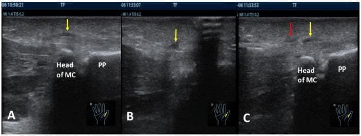 A composite of three musculoskeletal ultrasound images (A, B, and C) in the longitudinal plane of a right thumb, demonstrating the A1 pulley and adjacent anatomical structures for trigger finger release. Panel A (Pre-procedure) shows the 'Head of MC' (metacarpal) and 'PP' (proximal phalange), with a yellow arrow indicating a thickened A1 pulley, a classic sign of stenosing tenosynovitis. Panel B (Post-procedure) displays a yellow arrow pointing to hypoechoic fluid in the surrounding tissue immediately following a needle knife release procedure. Panel C (Complication) illustrates a technical failure in the 'blind group' procedure: a red arrow highlights an incorrect cutting direction or track after skin piercing, while a yellow arrow indicates that the actual thickened A1 pulley remains unaddressed at a separate location. This clinical imaging set highlights the limitations of blind needle knife release compared to guided interventions, emphasizing the risk of inaccurate targeting and tissue fluid accumulation.