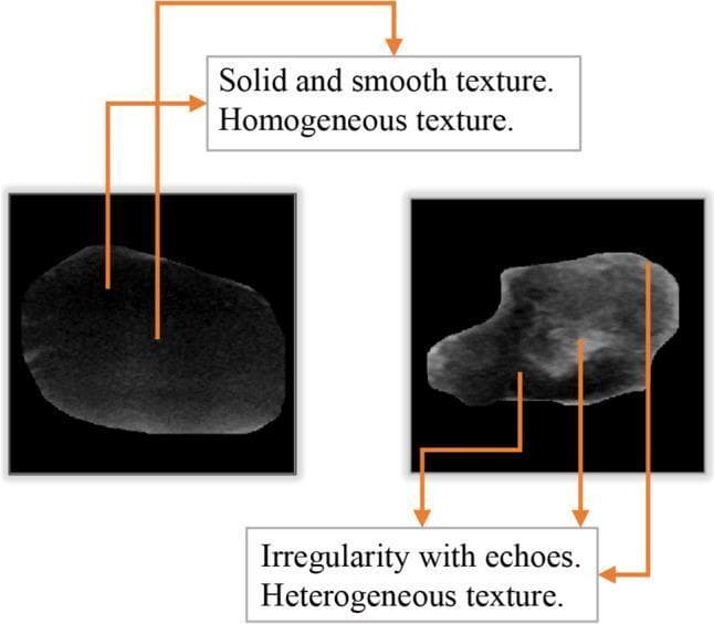 This Comparison Chart illustrates the distinguishing diagnostic features of benign and malignant breast tumors using ultrasound imaging. The image is divided into two clinical diagnostic frames. On the left, a benign tumor is presented, characterized by a regular, rounded boundary, a solid and smooth texture, and a homogeneous internal echo pattern. On the right, a malignant tumor is displayed, demonstrating key pathological indicators including highly irregular, branching boundaries and a heterogeneous internal texture. Orange arrows and labels highlight the 'internal echoes' and 'irregularity' present in the malignant mass compared to the 'homogeneous' and 'smooth' appearance of the benign lesion. This visual serves as an educational tool for medical training in breast imaging and radiology, specifically focusing on morphological features such as solidity and echogenicity used to differentiate tumor types. The material is relevant for oncology and diagnostic imaging specialties at an intermediate learning level.