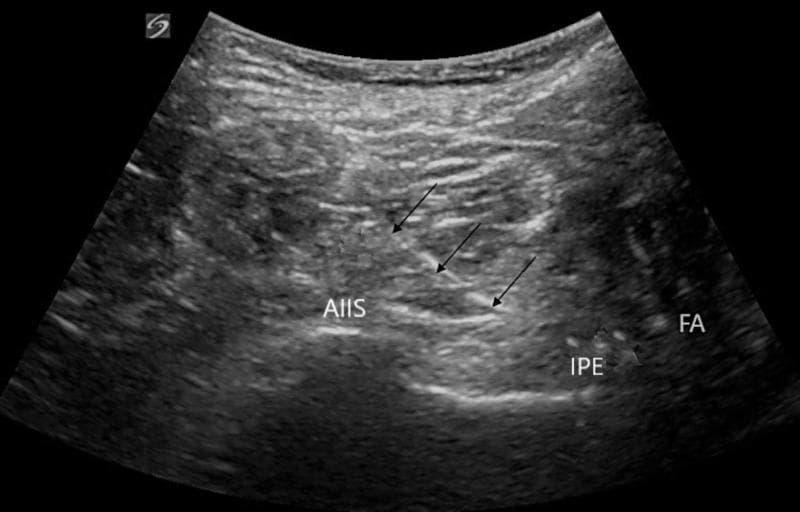 This diagnostic ultrasound image demonstrates the anatomical landmarks and needle trajectory for a Pericapsular Nerve Group (PENG) block, a regional anesthesia technique for hip pain. The image, captured in a transverse plane using a curvilinear transducer, shows key hyperechoic (bright) bony structures: the Anterior Inferior Iliac Spine (AIIS) and the more medially located Ilio-Pubic Eminence (IPE). The Femoral Artery (FA) is visible as a hypoechoic (dark), circular pulsatile structure lateral to the IPE. A series of three black arrows indicate the in-plane needle trajectory, advancing from a lateral to medial direction. The echogenic needle tip is positioned in the fascial plane between the psoas tendon and the pubic ramus, adjacent to the IPE, which is the target site for local anesthetic deposition. This visualization is critical for clinicians to ensure accurate needle placement while avoiding neurovascular structures during regional nerve blocks in orthopedic surgery or emergency medicine.