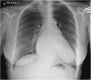 This diagnostic image is a posteroanterior (PA) erect chest X-ray demonstrating signs of pulmonary venous hypertension and early interstitial edema. Key visual findings include cephalization of the pulmonary vasculature, or 'vascular diversion,' characterized by prominent, dilated pulmonary vessels in the upper lung fields relative to the lower lung fields. In the right lower lung zone, there is evidence of interstitial thickening and increased lung markings, consistent with septal edema (Kerley lines). The cardiac silhouette appears slightly enlarged, though the primary focus is the pulmonary vascular congestion. These findings are typical of heart failure or cardiac-related fluid overload. The image serves as an educational tool for identifying the radiological progression from pulmonary venous congestion to interstitial edema, highlighting the redistribution of blood flow and the accumulation of fluid in the lung parenchyma and septal spaces.