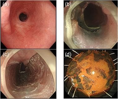 A multi-panel clinical image depicting an endoscopic submucosal dissection (ESD) procedure for metachronous early esophageal squamous cell carcinoma (SCC) in the setting of a pre-existing esophageal stricture. Panel (a) shows an endoscopic view of a severe esophageal stricture with a pinhole-sized lumen and surrounding fibrotic, erythematous mucosa resulting from a previous ESD scar. Panel (b) demonstrates the intraprocedural release of the stricture following mucosal incision and partial submucosal dissection of the lesion at the oral aspect, resulting in a widened lumen. Panel (c) shows the post-procedural ulcer base, characterized by a smooth, denuded surface without visible residual submucosal tissue. Panel (d) displays the en-bloc resected specimen, pinned for pathological examination. The specimen is roughly circular, showing orange-tinted mucosa with distinct dark-stained areas (likely from Lugol's iodine staining) identifying the squamous cell carcinoma lesion. This series illustrates the successful management of complex esophageal lesions located within fibrotic strictures using conventional endoscopic techniques.