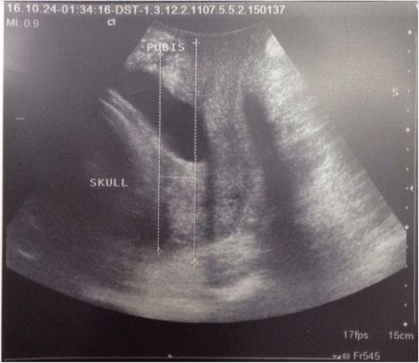 This diagnostic image is a translabial ultrasound (TLUS) captured in the sagittal plane, used for assessing fetal head descent during labor. The image illustrates the measurement of the 'fetal head–symphysis pubis distance' (HSPD). Key anatomical landmarks are labeled: the maternal 'PUBIS' (pubic symphysis) at the top and the fetal 'SKULL' on the left. Two vertical dotted caliper lines represent the reference axis, with a horizontal measurement line indicating the distance from the inferior-posterior margin of the pubic symphysis to the leading edge of the fetal skull. This sonographic parameter is clinically significant in obstetrics as a predictor for the mode of delivery and successful vaginal birth, often compared alongside the Bishop Score and cervical length. Machine metadata, including a Mechanical Index (MI) of 0.9, a frame rate of 17fps, and a depth scale of 15cm, are visible on the periphery.