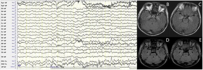 This composite image consists of an electroencephalogram (EEG) trace and comparative axial brain MRI scans, illustrating a case of LGI1 antibody-associated autoimmune encephalitis. Panel A displays a multi-channel ictal EEG showing rhythmic sharp wave discharges with progressive modulation of amplitude and frequency, localized primarily to the bilateral temporal regions, indicative of a subclinical seizure. Panels B and C are pre-treatment axial MRI slices using Fluid-Attenuated Inversion Recovery (FLAIR) sequences, demonstrating prominent hyperintense (high signal) lesions in the bilateral hippocampus, a hallmark finding in limbic encephalitis. Panels D and E show follow-up axial FLAIR MRI scans approximately three months later, following immunotherapy. These subsequent images reveal a significant resolution and reduction of the previously noted hippocampal hyperintensities, demonstrating a positive radiologic response to treatment. The collection serves to correlate neurophysiological seizure activity with structural inflammatory changes and their resolution in autoimmune encephalitis.