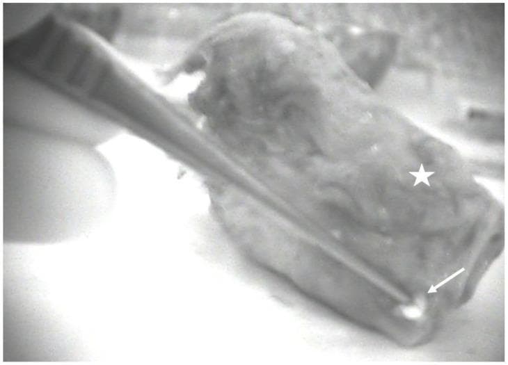 This diagnostic image demonstrates a total laryngectomy specimen (marked with a white star) captured using near-infrared (NIR) autofluorescence imaging in a lateral ex-vivo view. The specimen is an irregularly shaped, multi-contoured soft tissue mass. The focus of the clinical demonstration is a highly hyperfluorescent, bright white focal point (indicated by a white arrow) located at the periphery of the laryngeal tissue, representing an autofluorescent parathyroid gland. The NIR modality highlights the intrinsic fluorescence of the parathyroid tissue, creating a sharp contrast against the dimmer, more uniform background of the surrounding laryngeal and connective tissues. This imaging technique is utilized in surgical oncology and endocrine surgery to facilitate the identification and preservation or auto-transplantation of parathyroid glands during major neck dissections, such as total laryngectomy for laryngeal cancer, where devascularization of these glands is a common surgical risk.