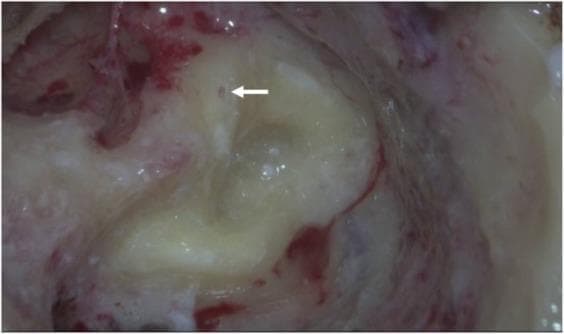 This clinical otologic photograph captures an intraoperative view of the left mastoid cavity during a revision labyrinthectomy in a patient with Meniere’s disease. The image focuses on the vestibular system, specifically the three semicircular canals previously treated with triple semicircular canal plugging (TSCP). The superior semicircular canal (SSC) and posterior semicircular canal (PSC) exhibit successful occlusion; the plugging fascia has undergone fibrotic and ossifying changes, resulting in the complete disappearance of the canal lumens. In contrast, the horizontal semicircular canal (HSC) demonstrates incomplete occlusion. A white arrow points to a small residual lumen within the HSC where endolymph fluid remains visible, indicating a failure of the initial plugging material to achieve full mechanical blockage. This visual evidence of incomplete occlusion highlights the anatomical basis for recurrent vestibular symptoms and provides clinical correlation for abnormal video head impulse test (v-HIT) or caloric test results in post-surgical patients.
