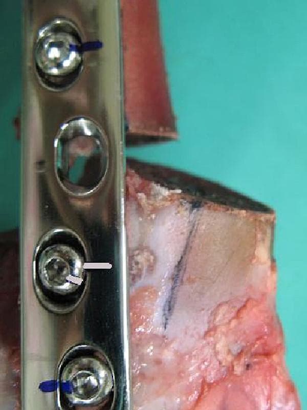 This clinical photograph displays a close-up of a Limited Contact Dynamic Compression Plate (LC-DCP) construct used in an orthopedic biomechanical study of femoral fracture fixation. The image illustrates a procedural failure analysis of an internal fixation system. A significant osteotomy gap is visible between the proximal and distal bone segments, showing asymmetrical widening at the cranial aspect and narrowing at the caudal aspect, indicating a cranial tilt and rotational displacement of the distal fragment. Metal screws are numbered for testing, with screw No. 5 specifically highlighting mechanical failure. The black marker lines on the screw head and the plate surface, which were originally aligned, show a clear deviation. This misalignment serves as visual confirmation of screw loosening and rotation within the plate hole during axial loading. The image is used to demonstrate the structural weakness of bone-plate constructs under compression and to identify signs of hardware migration in orthopedic surgery.