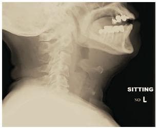 This lateral soft tissue neck radiograph demonstrates classic features of acute epiglottitis in an adult patient. The primary finding is a significantly enlarged, rounded, and radiodense epiglottis, exhibiting the pathognomonic 'thumbprint sign' (or thumbprinting). This replaces the normal, thin, leaf-like configuration of the epiglottis. The image also visualizes the aryepiglottic folds, which appear thickened, contributing to the narrowing of the supraglottic airway. Key anatomical landmarks include the mandible with dental restorations, the hyoid bone, and the cervical spine. The prevertebral soft tissues appear within normal limits for this projection. This diagnostic image is a critical educational tool for emergency medicine and otolaryngology, illustrating the radiographic manifestations of a potential airway emergency. The 'thumbprint sign' indicates severe inflammatory edema, usually requiring immediate clinical correlation with the patient's ability to maintain a patent airway and often necessitating direct visualization via laryngoscopy for definitive diagnosis.