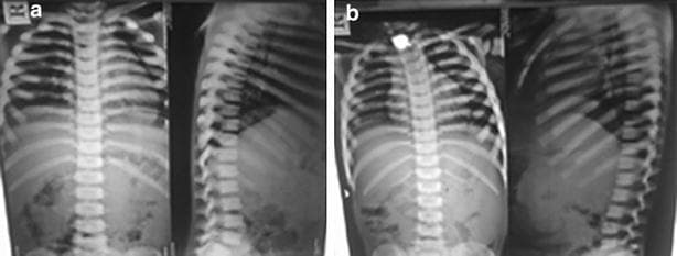 This diagnostic imaging set consists of two conventional X-ray panels (labeled 'a' and 'b') displaying anteroposterior (AP) and lateral views of the thoracolumbar spine and rib cage in two pediatric patients (aged 5 and 8 years). The primary radiological finding is marked sclerosis of the superior and inferior vertebral endplates throughout the spine. This selective thickening creates a classic 'sandwich vertebrae' appearance, where the opaque endplates contrast sharply with the relatively lucent center of the vertebral bodies. Additionally, there is a generalized, homogeneous increase in bone density (osteosclerosis) involving the ribs and visible pedicles, leading to a loss of the normal corticomedullary differentiation. These skeletal features are pathognomonic for osteopetrosis (marble bone disease), illustrating the progressive failure of osteoclast-mediated bone resorption. The images serve as an educational example of metabolic bone disorders and their characteristic radiographic manifestations in a clinical genetics or pediatric radiology context.