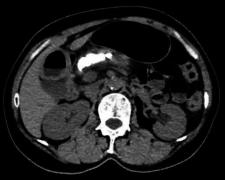 This axial non-contrast-enhanced computed tomography (CT) scan of the abdomen demonstrates classic imaging features of chronic pancreatitis. The primary finding is a series of dense, hyperattenuating (bright) focal areas within the pancreatic parenchyma, consistent with intraductal pancreatic stones or parenchymal calcifications. The largest calcification is visible in the region of the pancreatic head and body. The pancreas itself appears somewhat heterogeneous and atrophic. Surrounding anatomical structures are clearly visible, including the liver (right upper quadrant), the spleen (left upper quadrant), and bilateral kidneys. A cross-section of a lumbar vertebra is centered posteriorly. The stomach is visible anterior to the pancreas, appearing partially distended with air. No significant peripancreatic fluid collections or inflammatory stranding are immediately evident in this slice, suggesting a chronic rather than acute inflammatory state. This diagnostic image serves as a clinical example for medical students and gastroenterology fellows to identify obstructive pancreatic ductal lithiasis in the context of chronic pancreatitis.