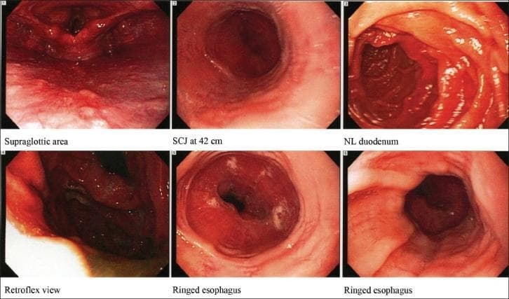 This composite of six clinical photographs demonstrates various endoscopic views from an upper gastrointestinal endoscopy (Esophagogastroduodenoscopy). The primary educational focus is on panels 5 and 6, which exhibit a 'ringed esophagus' (trachealization), a classic endoscopic hallmark of eosinophilic esophagitis (EoE). These panels reveal concentric, circular mucosal ridges or rings that cause a corrugated appearance and luminal narrowing in the distal esophagus. The esophageal mucosa appears erythematous with subtle longitudinal furrowing and small white exudates, representing eosinophilic microabscesses. Other panels include the supraglottic area, the squamocolumnar junction (SCJ) at 42 cm, a retroflexed view of the cardia, and the normal appearing (NL) duodenum. This visual material is critical for training in gastroenterology, specifically for identifying inflammatory conditions of the esophagus and differentiating them from mechanical strictures or gastroesophageal reflux disease (GERD).