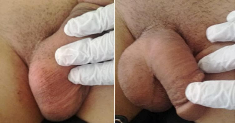 Clinical photograph showing a side-by-side comparison of the male external genitalia during a physical examination. The images depict significant scrotal enlargement and distension, characteristic of a bilateral hydrocele or varicocele. The scrotal skin appears erythematous and stretched, with visible wrinkling and rugosity. Gloved hands are shown palpating the structures to assess for fluid collection, masses, or spermatic cord abnormalities. This visual serves as a clinical example of scrotal swelling in the context of multi-system disease, such as Langerhans Cell Histiocytosis (LCH), where inguinal and genital involvement may occur. The educational focus is on the visual inspection and manual examination of the scrotum to distinguish between normal anatomy and pathological swelling or fluid accumulation.