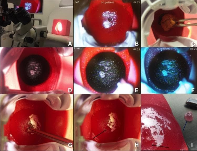 A composite clinical educational image (Panels A–I) demonstrating the use of a cervical colposcopy and biopsy simulator for gynecological training. (A) Setup showing a ZEISS colposcope and a 3D-printed vaginal/cervical phantom. (B-F) Sequential colposcopic views of the artificial cervix: (B) pre-treatment cervix with red surface and simulated white dysplastic areas; (C-E) application of Lugol’s iodine illustrating the Schiller test, where normal glycogen-rich tissue turns dark brown/black (iodine-positive) and abnormal dysplastic tissue remains white/pale (iodine-negative); (F) colposcopy using a green filter to enhance vascular contrast and lesion margins. (G-I) Biopsy procedure: (G) insertion and positioning of biopsy forceps at the simulated lesion site; (H) post-procedural view showing a visible punch biopsy defect (black arrow); (I) macroscopic view of the extracted simulator tissue (blue arrow) alongside the donor site on the cervical model. The material simulates the appearance and texture of the human cervix to facilitate training in identifying squamous intraepithelial lesions and performing diagnostic biopsies.