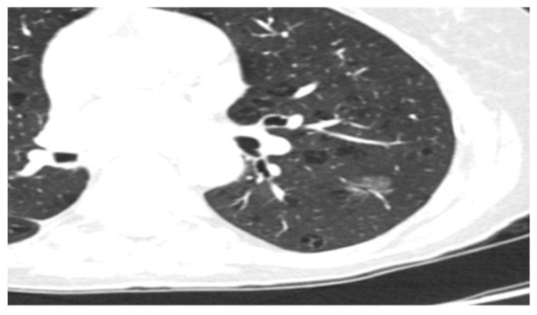 Diagnostic axial CT scan of the chest presented in lung window settings, demonstrating a localized area of pathology within the pulmonary parenchyma. The primary finding is a solitary, pure ground-glass nodule (GGN) located in the peripheral region of the left lung. This nodule is characterized by a hazy increase in lung density that does not obscure the underlying bronchial and vascular structures, consistent with adenocarcinoma in situ (AIS). The nodule exhibits a rounded morphology with ill-defined borders that blend into the surrounding normal lung tissue. There are no associated signs of solid components, pleural retraction, or spiculated margins. The background lung parenchyma appears otherwise clear with normal vascular markings. This image serves as a clinical example of early-stage lung adenocarcinoma screening and the radiographic features used to differentiate non-solid nodules from solid pulmonary masses.