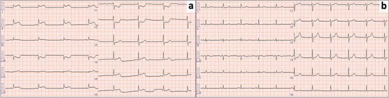 This diagnostic image displays a comparison chart containing two 12-lead electrocardiogram (ECG) recordings, labeled 'a' and 'b'. Panel 'a' illustrates acute cardiac changes during an episode of coronary vasospasm. It shows significant, diffuse ST-segment elevation in the inferior leads (II, III, aVF), the high lateral leads (I, aVL), and the precordial leads (V4–V6), alongside reciprocal ST-segment depression in leads V1 and V2. These findings are characteristic of a transmural injury pattern or Prinzmetal angina. Panel 'b' shows a follow-up ECG recorded 24 hours later, demonstrating a complete resolution of the ST-segment abnormalities and a return to a normal sinus rhythm with baseline isoelectric ST segments. The comparison serves as an educational tool for identifying transient ST-elevation myocardial infarction (STEMI) patterns induced by drug-related vasospasm, such as that caused by paclitaxel, and highlights the reversible nature of the electrical findings once the spasm resolves.