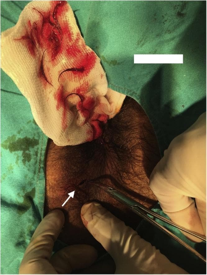 Clinical photograph of a surgical procedure addressing a perianal pilonidal sinus in a 24-year-old male. The patient is positioned in the prone position, and the perianal skin is visible with significant terminal hair growth. A gloved surgeon is using curved surgical forceps to explore a small punctum (sinus opening) located at the 7 o’clock position relative to the anus, highlighted by a white arrow. Adjacent to the operative site is a surgical gauze pad containing blood and several extracted hairs, which were removed from the subcutaneous cavity. The image demonstrates the hallmark clinical finding of pilonidal disease: a sinus tract containing a nest of hair. The surrounding field is draped with sterile green surgical drapes. This visual highlights the presentation and initial surgical management (debridement and hair removal) of a rare perianal manifestation of pilonidal sinus disease, which is distinct from the more common sacrococcygeal location.