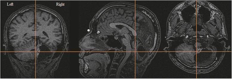 This diagnostic image displays three T1-weighted MRI views of the brain: coronal (left), sagittal (center), and axial (right). The imaging focuses on the posterior fossa, specifically the cerebellum. Orange crosshair lines intersect at a mural nodule of a pilocytic astrocytoma, located in the cerebellar vermis adjacent to the medulla oblongata. A large, hypointense cyst associated with the tumor is clearly visible, occupying the majority of the right cerebellar hemisphere and causing significant architectural asymmetry compared to the left side. The sagittal view provides a lateral perspective of the tumor's extension and its proximity to the brainstem. This image is used to demonstrate the classic morphological presentation of a cystic pilocytic astrocytoma, including the contrast between the solid mural nodule and the expansive cystic component. It serves as an educational reference for neuroradiology and neurosurgery in identifying pediatric cerebellar tumors and their anatomical relationships to midline structures.