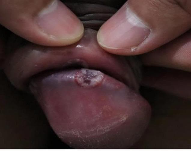 This clinical photograph shows a close-up view of a penile lesion located on the glans penis. The primary finding is a solitary, well-demarcated, circular ulcer approximately 5-10mm in diameter. The lesion exhibits a distinct morphology characterized by a raised, whitish, indurated peripheral border and a central base that is purplish-red or dusky in hue. The surrounding glans tissue appears mildly erythematous and glossy. This visual presentation is characteristic of educational material focused on sexually transmitted infections (STIs), specifically demonstrating an ulcerative condition of the male genitalia. The clinical significance involves the differential diagnosis of genital ulcers, such as primary syphilis (chancre), chancroid, or herpes simplex virus, although the clean-based, sharply defined appearance of the border is particularly illustrative of specific dermatological manifestations of balanitis or infectious ulcers.