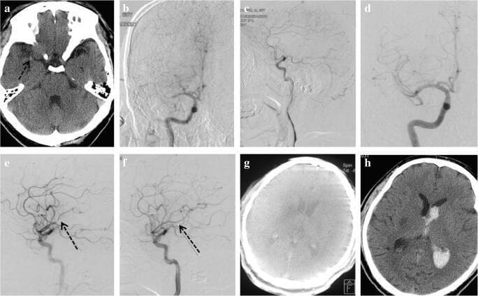 This composite of clinical imaging illustrates a case of acute ischemic stroke and its management. Image (a) is a non-contrast head CT showing a hyperdense right middle cerebral artery (MCA) sign, indicative of an acute thrombus. Images (b) and (c) are frontal and lateral digital subtraction angiograms (DSA) demonstrating a complete occlusion of the M1 segment of the right MCA. Subsequent DSA frames (d-f) capture spontaneous recanalization following intravenous thrombolysis (IVT); (d) shows initial flow restoration, (e) reveals thrombus migration to the MCA bifurcation, and (f) demonstrates complete vessel patency after thrombus resolution. Image (g) is a Dyna-CT used for immediate post-procedure assessment, showing no early hemorrhage. However, image (h) is a follow-up non-contrast CT at 24 hours post-IVT, revealing a secondary hemorrhagic transformation within the right thalamus and ventricular system. This series serves as an educational example of the 'hyperdense MCA sign,' dynamic recanalization during thrombolysis, and the potential complication of intracranial hemorrhage.