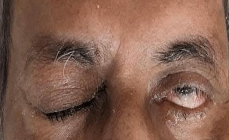 Clinical photograph of an adult male's orbital region, demonstrating classic signs of a right-sided third cranial nerve (oculomotor nerve) palsy. The right eye exhibits complete ptosis, with the upper eyelid almost entirely covering the globe. Upon manual elevation (implied by clinical context), the right eye shows exotropia (outward deviation) and mydriasis (dilated pupil). The left eye remains in a primary position with normal eyelid elevation and pupillary size, providing a comparative baseline. The skin shows age-related changes, including periorbital rhytids and slight discoloration. Notable clinical findings include traumatic mydriasis and ocular misalignment, which are indicative of underlying neurological compromise, such as subarachnoid hemorrhage or cavernous sinus thrombosis as mentioned in the clinical history. This image serves as a teaching tool for recognizing the triad of ptosis, exotropia, and mydriasis associated with oculomotor nerve dysfunction in the context of head trauma.