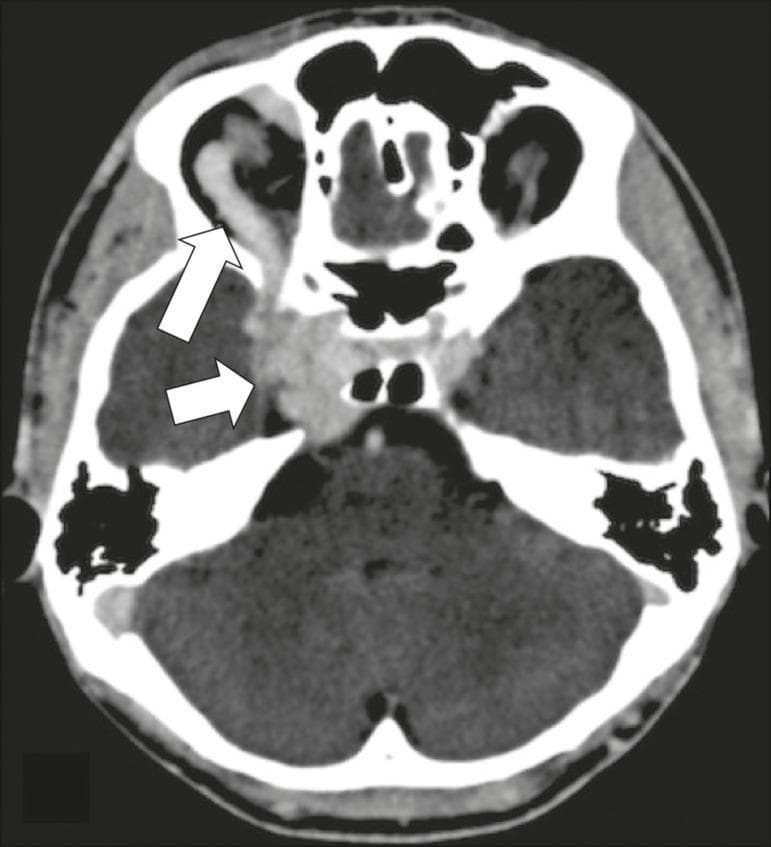Axial CT angiography of the head demonstrating key diagnostic findings of a carotid-cavernous fistula (CCF). The image shows significant dilation and early contrast enhancement of the right cavernous sinus. This is accompanied by a markedly dilated and tortuous right superior ophthalmic vein (SOV), indicated by a white arrow, reflecting retrograde arterialized blood flow. Clinical manifestations secondary to these vascular changes are visible, including right-sided exophthalmos (proptosis) and enlargement of the extraocular muscles. The medial deviation of the right globe suggests convergent strabismus, clinically associated with abducens nerve (CN VI) compression within the cavernous sinus. This educational image serves to illustrate the classic radiological triad of cavernous sinus enlargement, superior ophthalmic vein dilation, and proptosis in the context of neurovascular pathology.