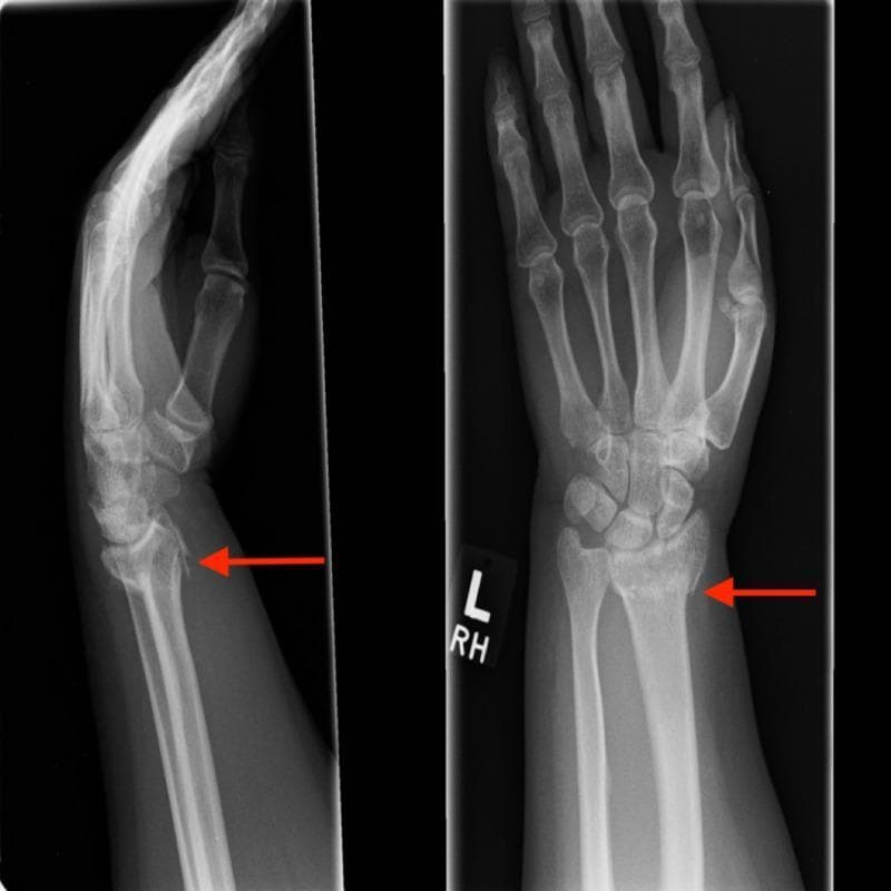Two-view radiographic study (Lateral and Posteroanterior) of the left wrist and hand demonstrating an extra-articular distal radius fracture. The lateral view on the left shows a Colles-type injury pattern with prominent dorsal angulation and dorsal comminution of the fracture fragments. The red arrow highlights the displacement and cortical disruption at the dorsal aspect of the distal radius. The PA view on the right identifies the fracture line extending across the metaphysis of the distal radius (red arrow), showing radial shortening and mild radial deviation. The carpal bones, including the scaphoid and lunate, appear intact without evidence of intra-articular extension. The distal radioulnar joint alignment is altered secondary to the radial displacement, though the ulna appears visually intact. This imaging is diagnostic for a common fracture resulting from a fall on an outstretched hand (FOOSH), illustrating typical deformities such as the 'dinner fork' deformity seen in clinical practice.