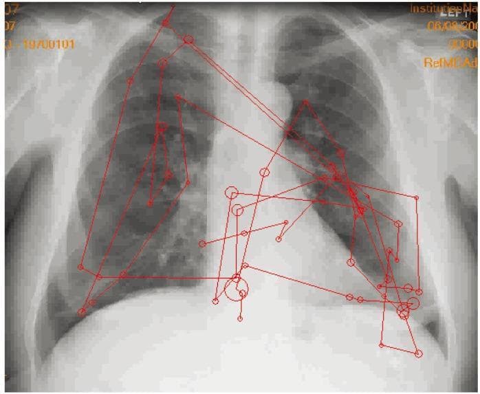 This diagnostic image is a posterior-anterior (PA) chest radiograph featuring a red eye-tracking overlay that illustrates a radiologist's visual search pattern. The underlying X-ray shows standard thoracic anatomy, including the lungs, heart silhouette, mediastinum, and rib cage. The red overlay consists of circles of varying diameters, representing 'fixations' where the viewer's foveal vision focused; larger circles indicate longer dwell times on specific anatomical features or suspicious findings. These circles are interconnected by straight red lines, which represent 'saccades' or the rapid eye movements between fixations. The scanpath demonstrates a systematic review, with clusters of fixations centered on the hila, lung fields, and the cardiac borders. This infographic serves as a pedagogical tool in radiology education to demonstrate perceptual strategies, the importance of foveal vision in detecting fine details, and the difference between expert and novice image interpretation patterns. It highlights the cognitive process involved in diagnostic image analysis.