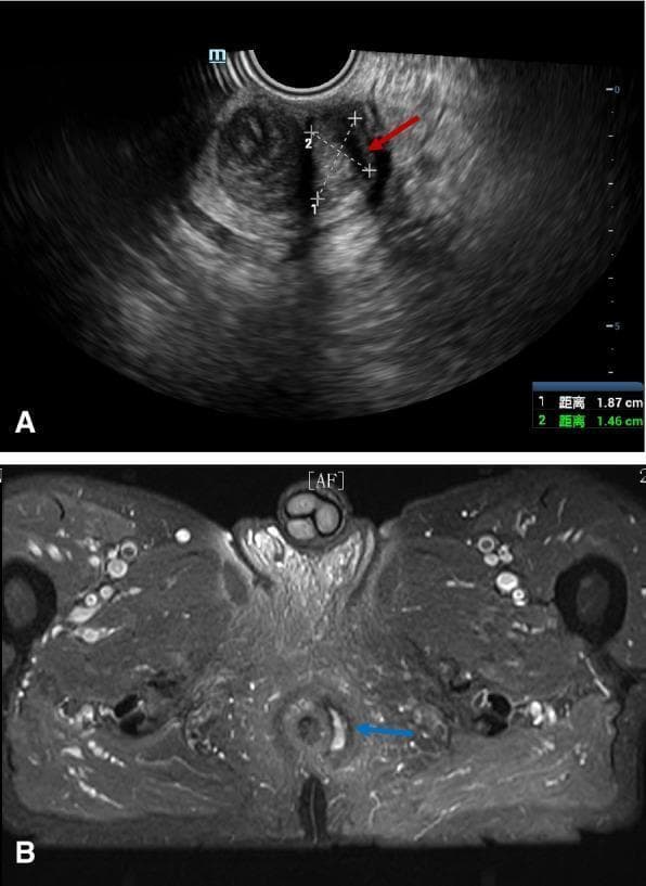 This composite diagnostic image illustrates a Type I anal fistula using two different modalities: 3D pelvic ultrasound (US) and magnetic resonance imaging (MRI). Image A shows a transrectal or pelvic 3D US presenting a heterogeneous perianal region. A red arrow indicates a hypoechoic, cavity-like tract representing the fistula, with calipers measuring its dimensions (1.87 cm and 1.46 cm). Image B is an axial T2-weighted or fat-suppressed MRI of the pelvic floor and anal canal. A blue arrow highlights a hyperintense (bright) signal adjacent to the anal canal, indicating an active inflammatory fistula tract or fluid collection. The comparison demonstrates the clinical utility of both US and MRI in identifying perianal fistulous disease, highlighting the fistula's spatial relationship to pelvic musculature and the anal canal. The images are aimed at an intermediate to advanced medical level, focusing on radiologic diagnosis and classification of anorectal pathologies.