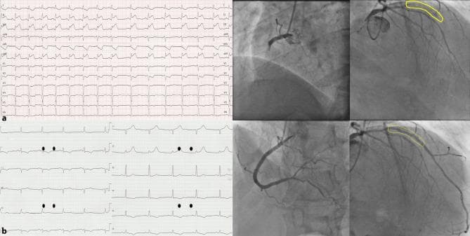 A comparison of 12-lead electrocardiograms (ECG) and invasive coronary angiograms demonstrating an acute myocardial infarction before and after primary percutaneous coronary intervention (pPCI). Row (a) displays a pre-procedural ECG showing significant ST-segment elevation in the inferior leads (II, III, aVF) diagnostic of an inferior wall STEMI. Adjacent angiograms reveal a total occlusion of the proximal right coronary artery (RCA) and a significant lesion in the left anterior descending artery (LAD) after the first septal branch (S1), highlighted by a yellow outline. Row (b) presents the post-procedural results, where the ECG shows successful ST-segment resolution and return to baseline. Corresponding angiograms demonstrate restored TIMI 3 flow and luminal patency in both the RCA and LAD following stent deployment. This clinical image illustrates the management of multi-vessel coronary artery disease in the setting of cardiogenic shock and acute myocardial injury, highlighting the correlation between electrical findings on ECG and anatomical revascularization via pPCI.