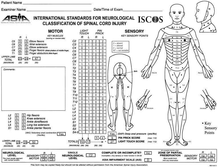 This is a completed International Standards for Neurological Classification of Spinal Cord Injury (ISNCSCI) form, commonly known as the ASIA (American Spinal Injury Association) Impairment Scale. The document consists of structured data tables and anatomical diagrams used to assess motor and sensory function following a spinal cord injury. The 'Motor' section evaluates key muscle groups for the upper (C5-T1) and lower (L2-S1) limbs on a 0-5 scale. This patient exhibits significant motor recovery, scoring 47/50 in the upper limb and 50/50 in the lower limb. The 'Sensory' section records light touch and pin prick scores for dermatomes C2-S4/5, using a 0-2 scale (absent, altered, normal). Sensory recovery is notably more limited than motor, with total scores of 27 for light touch and 9 for pin prick, indicating incomplete and asymmetric sensory preservation. The anatomical diagrams illustrate key sensory points across the body. The final assessment classifies the injury as an ASIA Impairment Scale (AIS) grade D, representing an incomplete spinal cord injury with preserved motor function below the neurological level.