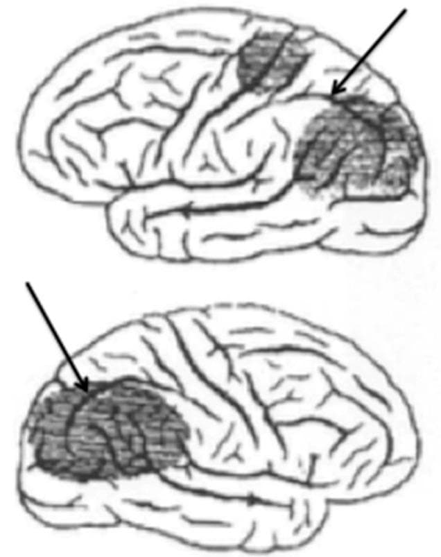 This medical illustration consists of two lateral-view drawings of a human brain, depicting bilateral cortical lesions associated with Bálint syndrome. Both diagrams are oriented with the anterior frontal lobe to the left and the posterior occipital lobe to the right. Darkly shaded regions highlight areas of tissue damage within the parietal lobes. The upper drawing displays two distinct patches of damage: a smaller anterior parietal lesion and a larger posterior parietal-occipital lesion. The lower drawing shows a more singular, large concentrated area of damage in the posterior parietal region. In both illustrations, black arrows point specifically to the intraparietal sulcus, which serves as a landmark dividing the parietal lobe into superior and inferior lobules. The diagram illustrates the pathophysiology of Bálint syndrome, specifically showing bilateral damage to the dorsal visual stream. This content is intended for intermediate to advanced medical students and neuroscience professionals studying neuroanatomy and clinical neurology syndromes related to visual processing and spatial orientation.