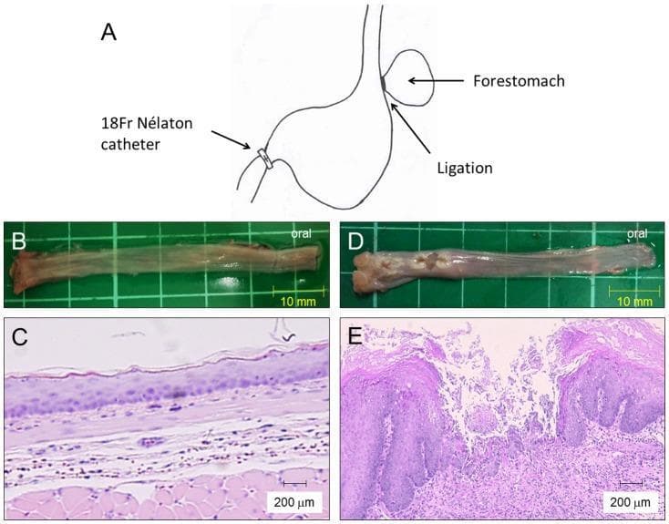This composite image illustrates a rat model of acid reflux esophagitis, comparing normal and pathological findings across macroscopic and microscopic scales. Panel A presents a surgical diagram depicting the induction of reflux via forestomach ligation and pyloric ring constriction using an 18Fr Nélaton catheter. Panel B shows the macroscopic appearance of a normal esophagus, characterized by a smooth, uniform mucosal surface. In contrast, Panel D displays a diseased esophagus with visible erosions and ulcers in the middle and lower regions. Panel C provides a histological view (H&E stain, 200µm scale) of normal esophageal tissue, showing a relatively thin squamous epithelium and minimal inflammatory infiltrate. Panel E demonstrates the pathophysiology of reflux esophagitis, featuring significant mucosal thickening, basal cell hyperplasia, and dense inflammatory cell infiltration within the lamina propria and submucosa. This figure serves as an educational tool for identifying structural and cellular changes associated with gastroesophageal reflux disease (GERD).
