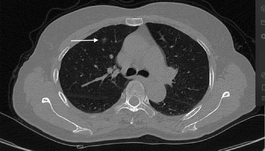 An axial-view non-contrast chest computerized tomography (CT) scan illustrating thoracic anatomy and pulmonary pathology. The image displays a cross-section of the thoracic cavity including the lungs, mediastinum, heart, and musculoskeletal framework (vertebral body, ribs, and scapulae). A white arrow points to a solitary, small pulmonary nodule with ground-glass opacity characteristics located in the anterior segment of the right upper lobe. The nodule is situated within the peripheral lung parenchyma, in relative proximity to the anterior chest wall and the fourth rib. The imaging demonstrates varying radiodensities: low-density (black) air-filled lung tissue, intermediate-density (grey) soft tissues of the heart and thoracic wall musculature, and high-density (white) cortical bone. This diagnostic image is used in medical education to teach anatomical localization of lung lesions and the visual identification of early-stage pulmonary nodules during radiological screening or pre-operative planning.