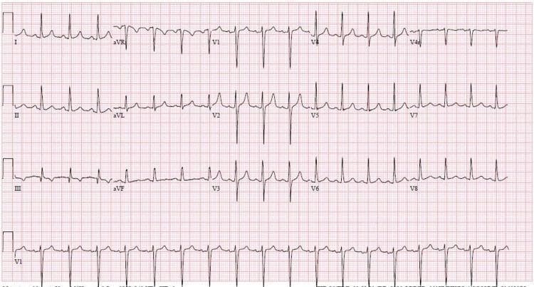 A 12-lead electrocardiogram (ECG) displayed on a standard red grid background. The tracing demonstrates sinus tachycardia, characterized by a heart rate exceeding 100 beats per minute with regular P-wave intervals preceding each QRS complex. A critical diagnostic feature is the presence of tall, 'peaked' or 'tented' T waves, particularly prominent in the precordial leads (V1-V8). These T waves exhibit high amplitude, a narrow base, and a symmetrical, sharp apex, which are classic electrographic manifestations of hyperkalemia. The QRS complexes appear relatively narrow, and the ST segment is essentially isoelectric. The limb leads (I, II, III, aVR, aVL, aVF) also show upright T waves, though they are less pronounced than those in the anterolateral distribution. This ECG is a key educational resource for identifying the cardiovascular effects of electrolyte imbalances, specifically severe hyperkalemia in the context of renal insufficiency and metabolic acidosis.