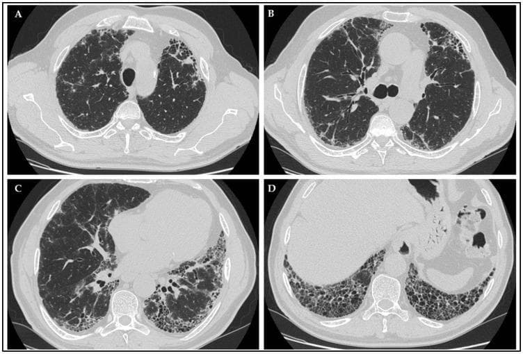 This composite diagnostic image displays four axial slices (A, B, C, D) of a high-resolution computerized tomography (HRCT) scan of the chest, illustrating a Usual Interstitial Pneumonia (UIP) pattern in a patient with Idiopathic Pulmonary Fibrosis (IPF). The scans demonstrate a classic subpleural and basal predominant distribution of interstitial lung disease. Key radiological features include: (A) early peripheral reticular opacities; (B and C) prominent traction bronchiectasis, characterized by the irregular dilation of bronchioles due to surrounding parenchymal fibrosis; and (D) extensive honeycombing, visible as clustered, thick-walled cystic airspaces in the subpleural regions of the lung bases. These findings collectively indicate advanced pulmonary fibrosis with architectural distortion. The image serves as an educational tool for identifying the hallmark CT characteristics of a UIP pattern, essential for the diagnosis of IPF and its differentiation from other interstitial lung diseases in a clinical pulmonology and radiology context.