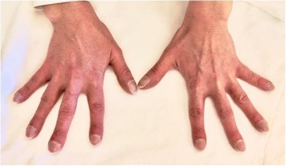 A clinical photograph displaying the dorsal view of both hands, demonstrating bilateral and symmetrical digital clubbing. The terminal phalanges of all digits show characteristic bulbous, drumstick-like swelling of the soft tissues. There is a visible loss of the normal Lovibond angle (the angle between the nail plate and the proximal nail fold), and the nails exhibit increased longitudinal curvature. The skin of the distal fingers appears mildly erythematous with a subtle dusky or cyanotic hue, consistent with chronic hypoxemia. This presentation is a classic clinical sign of underlying systemic conditions, such as cyanotic congenital heart disease (e.g., ventricular septal defect with Eisenmenger syndrome) or chronic pulmonary pathology. The image serves as an educational example for physical examination findings in cardiovascular and respiratory medicine, highlighting the morphology of hippocratic fingers.