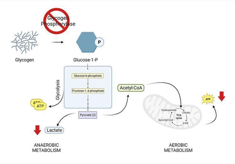 This pathophysiology diagram illustrates the metabolic consequences of Glycogen Phosphorylase deficiency, characteristic of McArdle disease (Glycogen Storage Disease Type V). The visual shows the metabolic flow starting with glycogen conversion to glucose-1-phosphate, which is overlaid with a red 'prohibited' sign on the Glycogen Phosphorylase enzyme, indicating an enzymatic block. The downstream effects are depicted through glycolysis (including glucose-6-phosphate and fructose-1,6-phosphate) leading to pyruvate. Two primary metabolic pathways are followed: 1) Anaerobic metabolism, where a red downward arrow indicates decreased lactate production, and 2) Aerobic metabolism, showing the transition of acetyl-CoA into the mitochondrion for the TCA cycle (featuring citrate, alpha-ketoglutarate, succinyl-CoA, and oxaloacetate). A yellow starburst labeled ATP is accompanied by a red downward arrow, signifying impaired adenosine triphosphate production in muscle cells. This diagram serves as an educational tool for understanding the biochemical basis of exercise intolerance and the lack of lactate rise during ischemic exercise tests in patients with McArdle disease.
