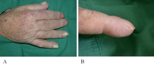 Two-panel clinical photograph illustrating manifestations of hypertrophic osteoarthropathy (HOA). Panel A presents a dorsal view of a right hand exhibiting generalized acral enlargement and diffuse edematous swelling. The fingers appear thickened, particularly at the distal aspects, and the nails show thickening and discoloration. Panel B provides a close-up lateral view of a finger demonstrating significant digital clubbing (Hippocratic fingers). Visible features include a loss of the normal Lovibond angle, a rounded bulbous deformity of the fingertip, and smooth, taut, shiny skin indicative of soft tissue hypertrophy and edema. Notable periungual erythema is present around the proximal nail fold. Clinically, these findings are highly suggestive of paraneoplastic syndrome, specifically secondary hypertrophic osteoarthropathy associated with underlying malignancies such as non-small cell lung carcinoma. The images serve as educational examples for recognizing secondary systemic signs of internal malignancy during physical examination.