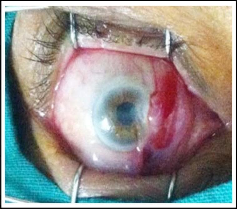 This clinical photograph captures a perioperative view of a human eye during a surgical procedure, likely for pterygium excision. The eye is held open by a wire lid speculum, providing full exposure of the bulbar conjunctiva and cornea. There is prominent focal conjunctival injection and subconjunctival hemorrhage on the nasal side, consistent with the administration of subconjunctival anesthesia (xylocaine 2%). A pterygium is visible as a fleshy, fibrovascular growth extending from the nasal bulbar conjunctiva onto the corneal surface. The cornea itself appears relatively clear except for the site of pterygium encroachment. This image serves as an educational reference for ophthalmology students and residents to understand local anesthesia administration and the preoperative presentation of pterygium within a sterile surgical field. Key landmarks include the limbus, the nasal bulbar conjunctiva showing vascular engorgement, and the eyelid margins retracted by surgical instrumentation.