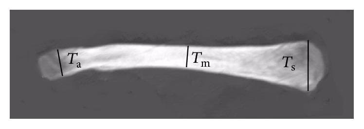 A clinical image of a human clavicle in the coronal plane, used to demonstrate quantitative morphometric analysis. The diagram illustrates the varying thickness of the bone across its longitudinal axis. Three specific measurement sites are indicated by vertical black lines perpendicular to the superior surface: 'Ts' represents the maximum thickness at the medial (sternal) end, which appears as the thickest portion; 'Ta' indicates the maximum thickness at the lateral (acromial) end; and 'Tm' identifies the minimum thickness located within the middle segment of the shaft. The image highlights the characteristic S-shaped curvature and the relative thinning of the clavicular midshaft compared to the expanded articular ends, a key anatomical feature relevant to orthopedic surgery, fracture management, and biomechanical modeling of the shoulder girdle.