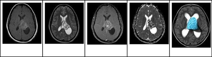 This composite of diagnostic images and a clinical illustration demonstrates a central neurocytoma in a 17-year-old patient. The series includes four axial MRI sequences and a corresponding schematic. A: Axial T1-weighted image shows a mass in the left lateral ventricle, adjacent to the septum pellucidum, exhibiting hyperintense signal. B: Axial T2-weighted image reveals the lesion is heterogeneously hyperintense with well-defined borders and no evidence of parenchymal invasion. Associated obstructive hydrocephalus is present, more prominent on the left. C: Contrast-enhanced axial T1-weighted image demonstrates heterogeneous enhancement of the mass. D: Apparent Diffusion Coefficient (ADC) map shows focal areas of restricted diffusion within the solid components. E: A medical illustration highlights the characteristic 'bubbly' appearance of a central neurocytoma within the ventricular system. The imaging features—location at the septum pellucidum and heterogeneous signaling—are classic for this WHO Grade 2 neuronal tumor.
