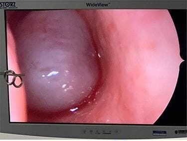 This diagnostic image is a nasal endoscopy frame displaying a large, obstructive cystic mass within the left nasal cavity, identified as the cystic component of an antrochoanal polyp (ACP). The mass appears rounded, translucent to semi-translucent, with a pale whitish-blue hue and a smooth, glistening surface that exhibits prominent light reflection, suggesting a fluid-filled or tense cystic nature. The surrounding nasal mucosa is erythematous and appears edematous, consistent with chronic inflammation or allergic rhinosinusitis. On the left side of the endoscopic field, the tips of a surgical instrument (likely Blakesley forceps) are visible, indicating an intraoperative context for polyp removal. The visual provides a classic example of the endoscopic appearance of nasal polyposis arising from the maxillary antrum and extending toward the choana. Key educational concepts include otolaryngological surgical approaches, recognition of benign nasal masses, and the characteristic appearance of antrochoanal polyps during functional endoscopic sinus surgery (FESS).