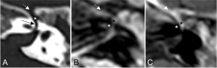 This figure presents axial plane imaging of the left temporal bone through three distinct modalities: high-resolution CT (A), MRI Fluid-Attenuated Inversion Recovery (FLAIR) sequence (B), and T1-weighted post-contrast MRI (C). Image A serves as an anatomical reference, identifying the bony canal of the labyrinthine segment of the facial nerve (black arrow), the bony canal of the greater petrosal nerve (white arrow), and the geniculate ganglion fossa (asterisk). Images B and C demonstrate clinical pathology in these same regions. Specifically, image B exhibits hyperintensity on the FLAIR sequence involving the geniculate ganglion (black asterisk), the labyrinthine portion of the facial nerve (white asterisk), and the proximal greater petrosal nerve (white arrow). Image C shows corresponding subtle T1 contrast enhancement in these anatomical locations. These imaging findings are characteristic of an inflammatory process affecting the facial nerve complex, such as Bell's palsy or secondary inflammation from acute otitis media, where nerve edema and blood-nerve barrier breakdown lead to hyperintensity and enhancement, respectively.