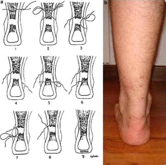 This composite image includes a percutaneous Achilles tendon repair schematic and a clinical follow-up photograph. Panel (a) presents a nine-step procedural diagram of the Ma and Griffith technique for acute Achilles tendon rupture. The line drawings illustrate the proximal and distal tendon stumps within the lower leg silhouette. The sequence details the percutaneous passage of sutures through the skin and tendon in a modified Bunnell-type weave, progressing from initial needle insertion (steps 1-3) to pulling the suture ends to approximate the tendon gap (steps 4-6) and final anchoring (steps 7-9). Panel (b) is a posterior clinical photograph of a patient’s right lower leg and ankle 90 days post-surgery. The image demonstrates a well-healed surgical site with minimal scarring, preserved calf contour, and a stable weight-bearing neutral foot position. The clinical focus is on minimally invasive orthopedic surgical techniques and the anatomical restoration of the gastroc-soleus complex.