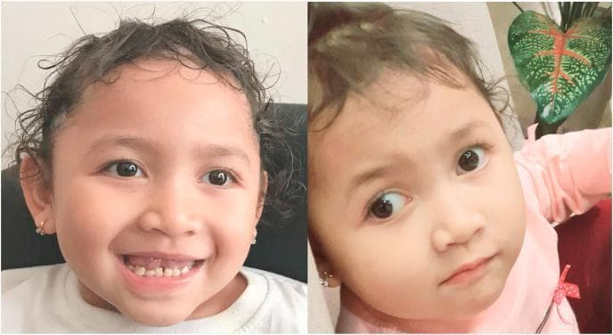 Two clinical photographs show the facial features of a 3-year-old child with Angelman Syndrome. Key diagnostic features include a characteristically wide mouth and an exuberant, happy facial expression. Dental examination reveals widely spaced teeth (diastema). Ocular findings demonstrate divergent strabismus, visible as a misalignment of the visual axes. The child exhibits generalized hypopigmentation of the skin and curly hair, which appears lighter than expected for her genetic background. Additionally, the head shape is suggestive of microcephaly. These visual findings represent the typical craniofacial phenotype of Angelman Syndrome, often associated with intellectual disability and ataxia. The images serve as an educational example of the neurodevelopmental and dermatological manifestations of this genetic condition, highlighting the importance of recognizing the 'happy puppet' disposition and associated dysmorphic features in pediatric clinical diagnosis.