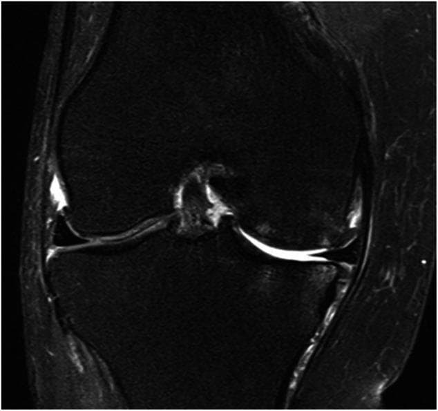 This diagnostic image is a coronal T2-weighted fluid-sensitive MRI of the knee joint, demonstrating significant degenerative changes characteristic of secondary osteoarthritis. The key pathological finding is the extrusion of the medial meniscus beyond the margin of the tibial plateau, likely following a posterior medial meniscus root tear (PMMRT). In contrast to the relatively well-preserved lateral compartment, the medial compartment shows marked joint space narrowing. There is a visible loss of articular cartilage thickness along the weight-bearing surfaces of the medial femoral condyle (MFC) and the medial tibial plateau (MTP), appearing as thinning and signal heterogeneity of the chondral surface. Subchondral bone marrow edema is present in the medial tibial plateau, indicated by hyperintense (bright) signal changes, which signifies increased mechanical stress. This image serves as an educational example of the rapid progression of post-traumatic osteoarthritis resulting from the loss of meniscal hoop stress and load-distribution functions.