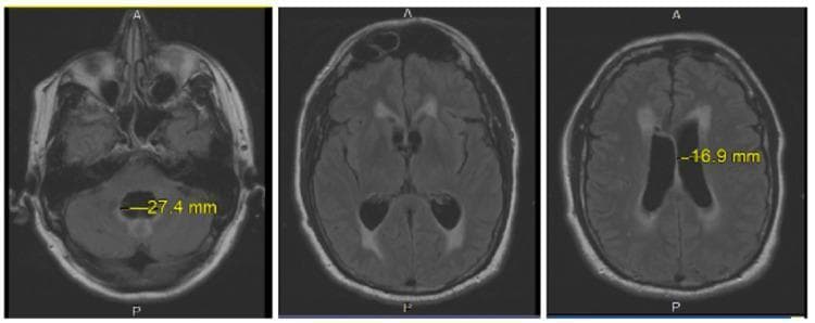 This diagnostic image set consists of three axial brain MRI slices (T2-weighted/FLAIR sequences) demonstrating features of obstructive or communicating hydrocephalus. The first slice (left) shows a transverse measurement of the fourth ventricle at 27.4 mm, indicating significant dilation within the posterior fossa. The middle and right slices display moderate ventriculomegaly of the lateral ventricles, with the right slice highlighting a transverse measurement of 16.9 mm. Notable periventricular T2/FLAIR hyperintensity is visible surrounding the margins of the lateral ventricles, particularly at the frontal and occipital horns. This visual finding is characteristic of transependymal CSF flow (interstitial edema), often seen in acute or subacute hydrocephalus where increased intraventricular pressure forces cerebrospinal fluid into the adjacent white matter. The images serve as an educational example of neuroradiological markers for hydrocephalus and the assessment of CSF dynamics.